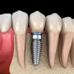 tipos-de-implantes-dentales