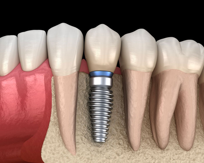 tipos-de-implantes-dentales