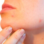 tratamientos-acne-para-escolares